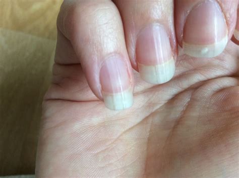 Lodräta ränder på naglarna